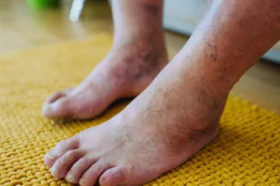 Diyabetik Periferik Nöropati Nedir? Belirtileri, Nedenleri ve Tedavi Yöntemleri